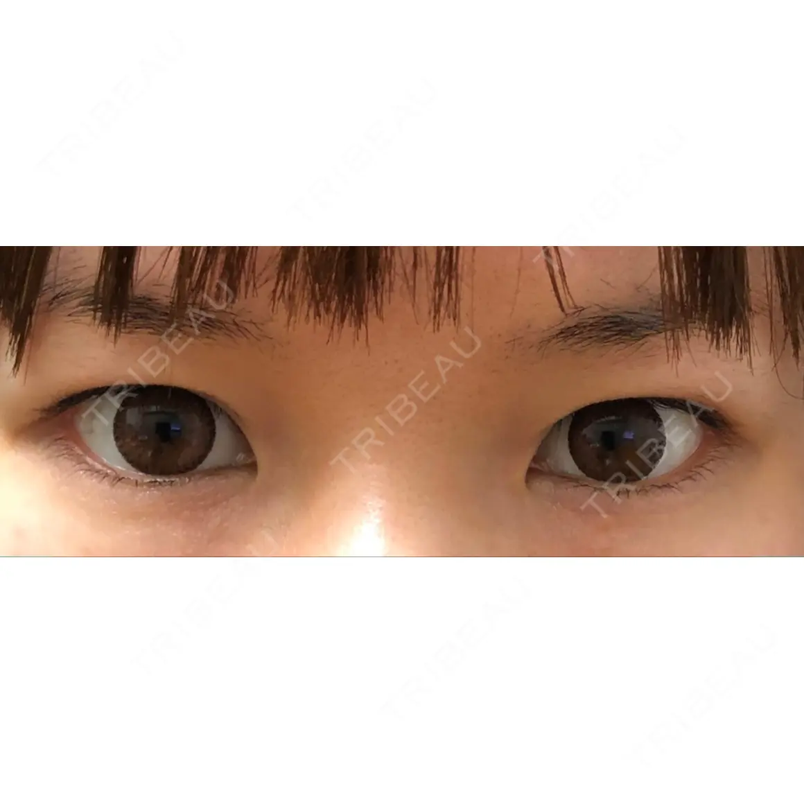 二重切開 / 目頭切開 / 眼瞼下垂（切開） / 上まぶたたるみ取り / 上まぶたの脂肪取り 湘南美容クリニック 名古屋栄院 AFTER
