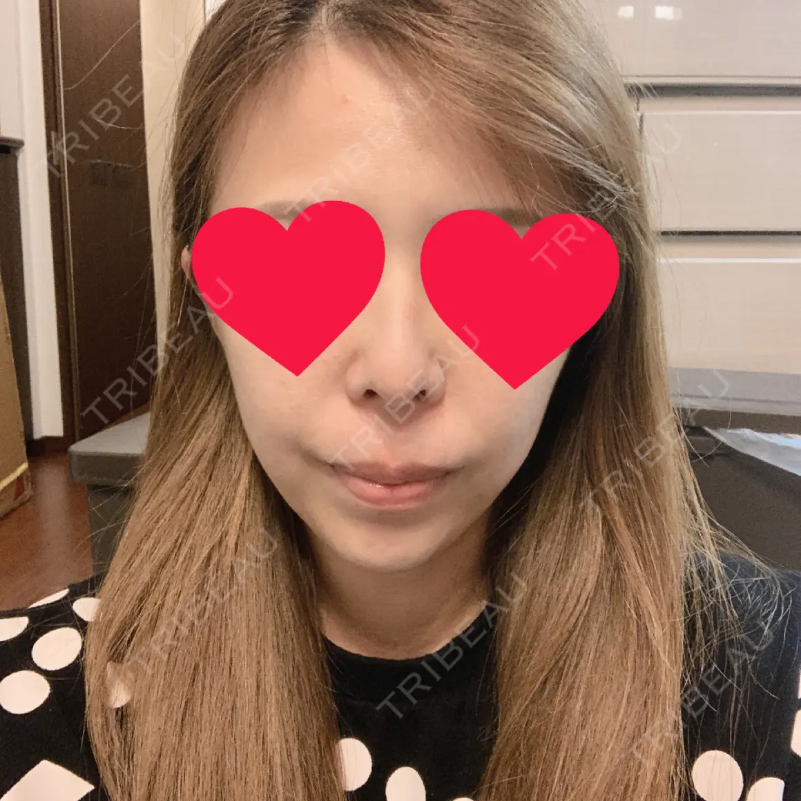 鼻尖形成（切開） / 鼻中隔延長（切開） / 軟骨移植 MIL CLINIC OSAKA AFTER
