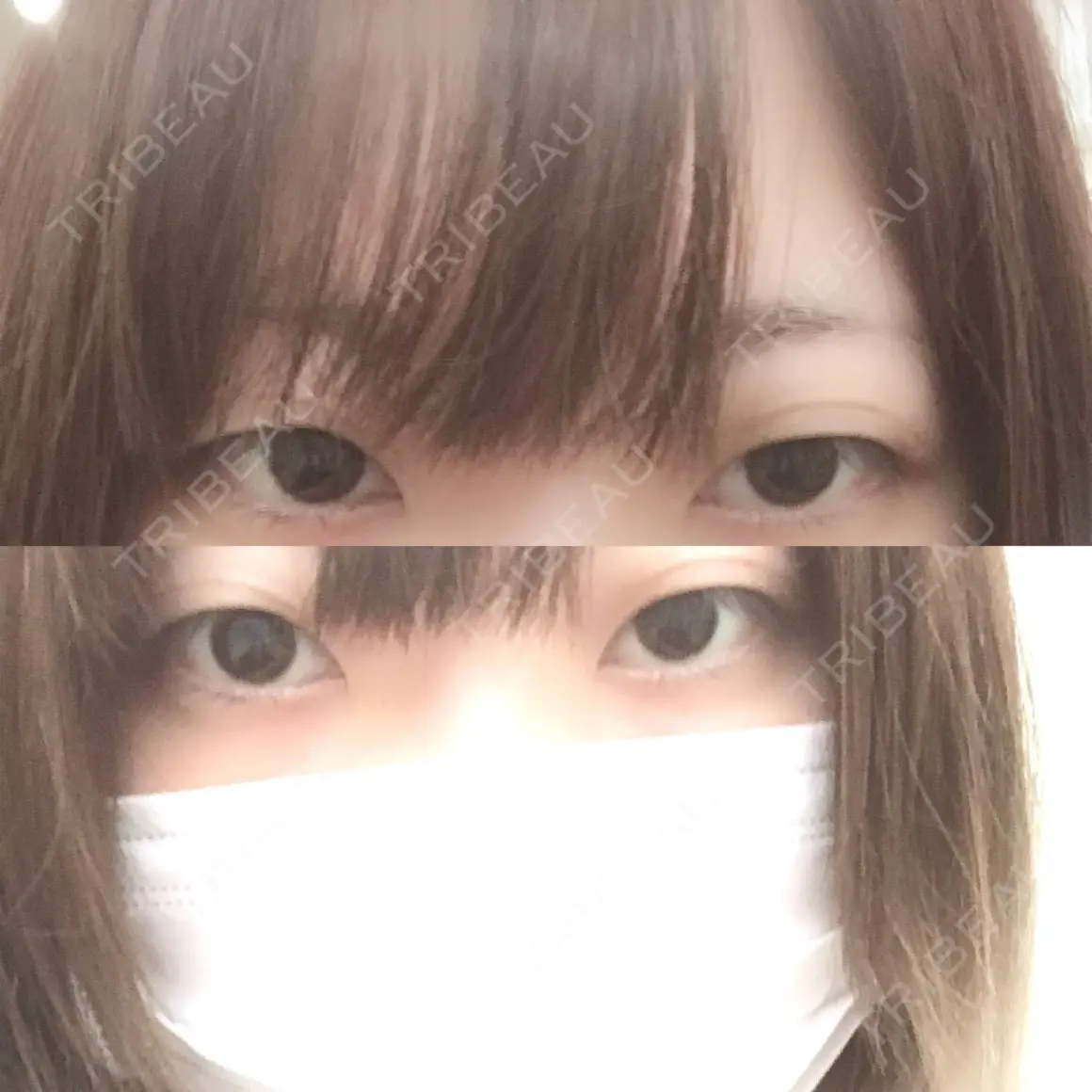 二重切開 / 眼瞼下垂（切開） みやび形成外科 AFTER