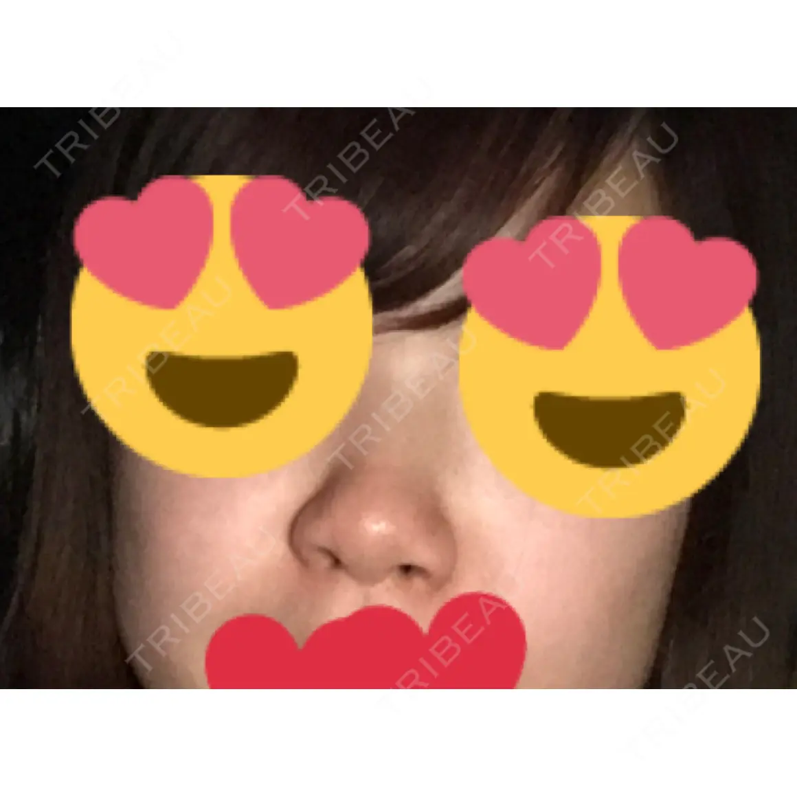 隆鼻術 / 鼻尖形成（切開） / 小鼻縮小（切開） / 額を丸く / 軟骨移植 / ヒアルロン酸注入（額） グローバルビューティークリニック 大阪院 AFTER