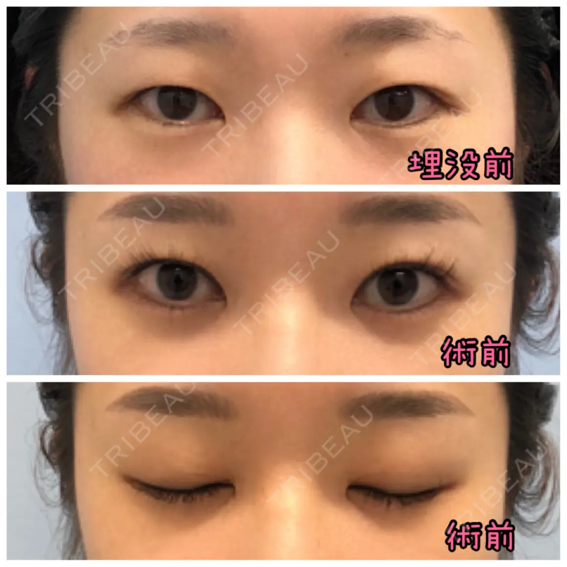 二重切開 / 目頭切開 / 眼瞼下垂（切開） / 目尻切開 / タレ目形成・グラマラスライン（切開） eクリニック 金沢本院 AFTER