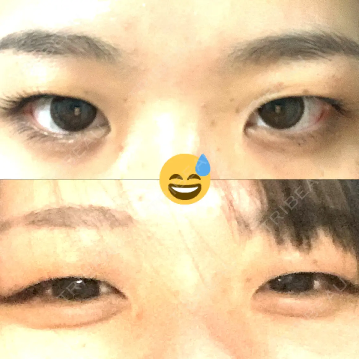 二重埋没 湘南美容クリニック 新宿本院 AFTER