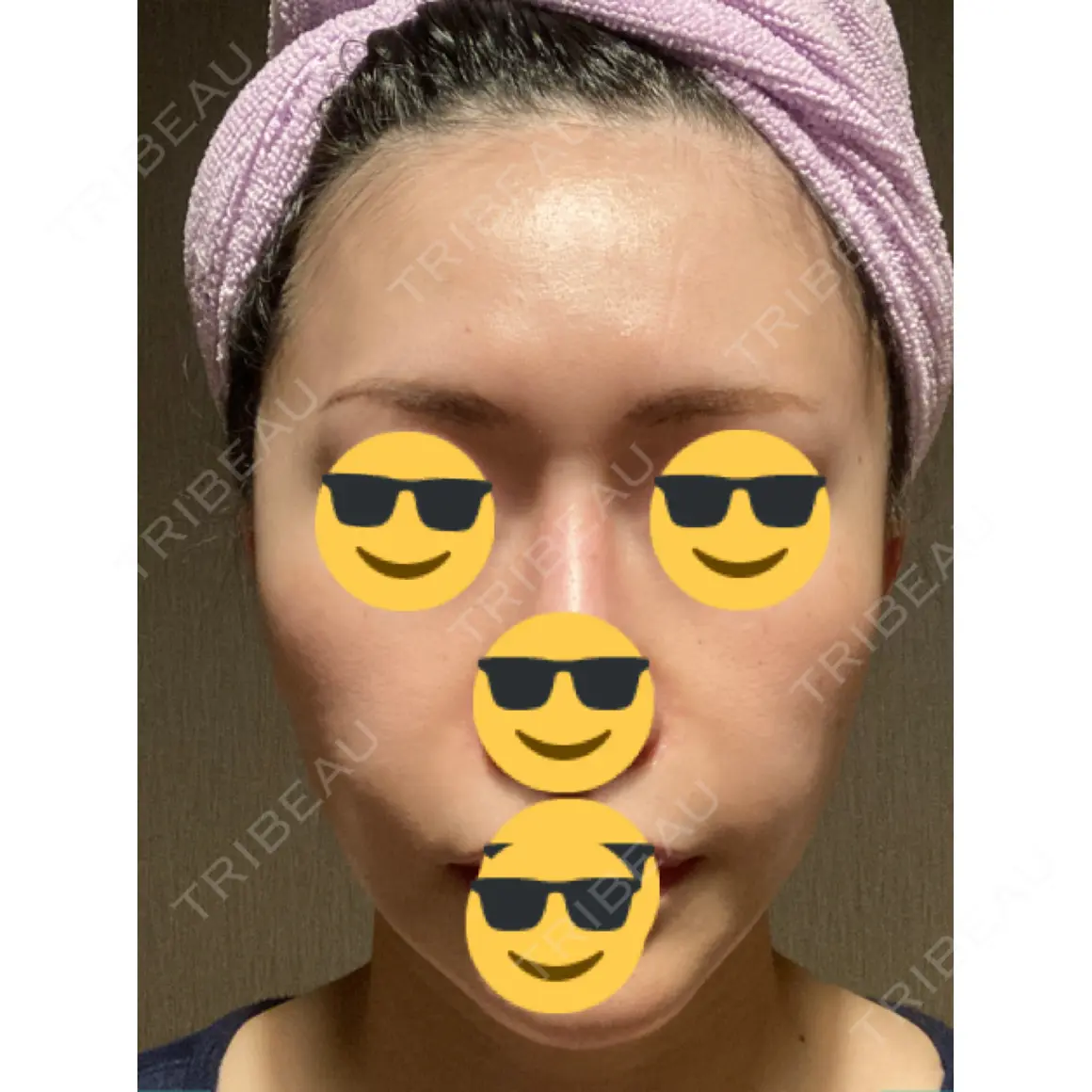水光注射（ハリ・美肌） / 脂肪溶解注射（顔） / PRP皮膚再生療法 プルージュ美容クリニック 赤羽院 AFTER
