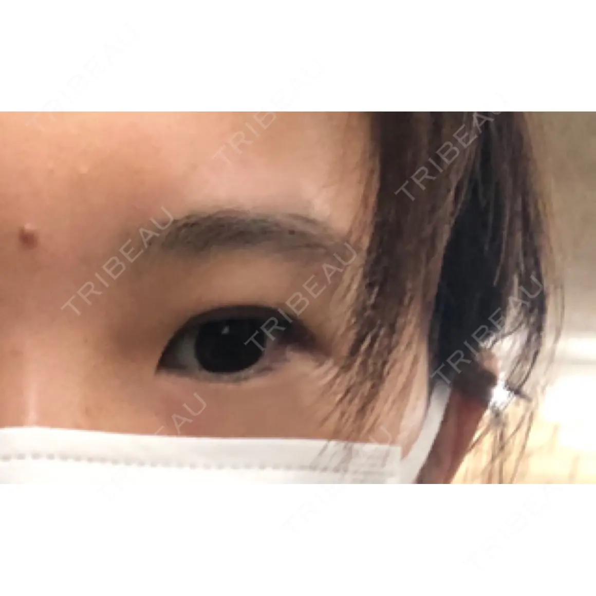 二重埋没 銀座高須クリニック AFTER