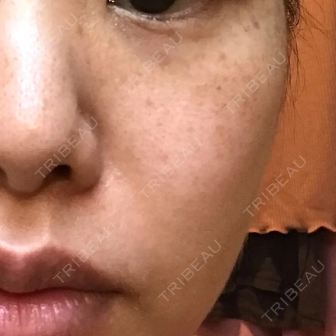 ピコレーザートーニング（美白・肝斑） レディアス美容クリニック恵比寿 AFTER