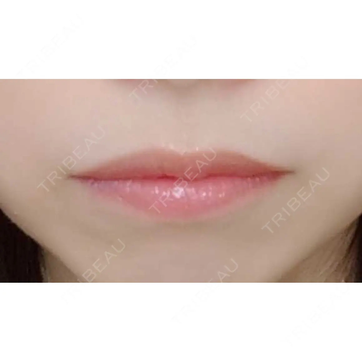 ヒアルロン酸注入（唇） 湘南美容クリニック 小倉院 AFTER