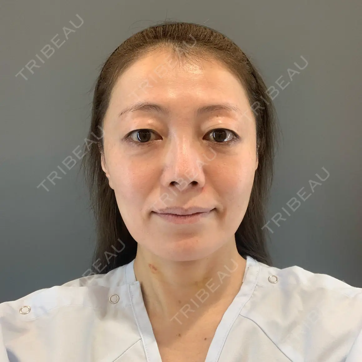 糸リフト / 脂肪吸引（顔） / 下まぶたたるみ取り / 眉下切開 / 脂肪注入（額） / 脂肪注入（輪郭） e:Top clinic（イートップクリニック） AFTER