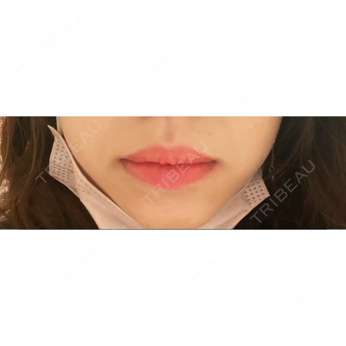 口唇縮小術 宇都宮竹内クリニック AFTER