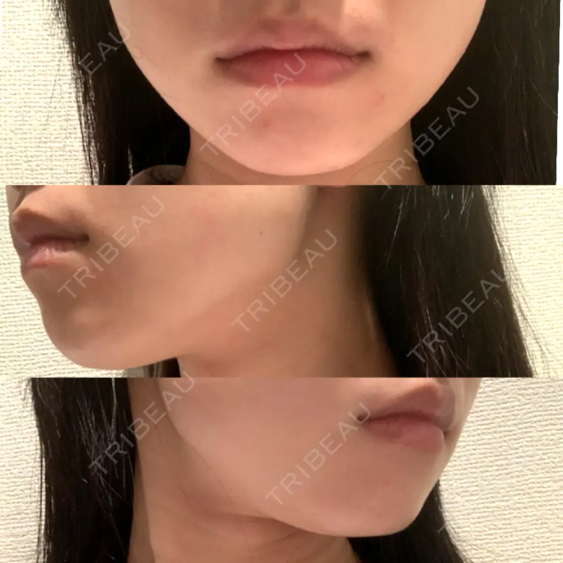 ボトックス（エラ・小顔） / 脂肪溶解注射（顔） id美容クリニック 銀座院 AFTER