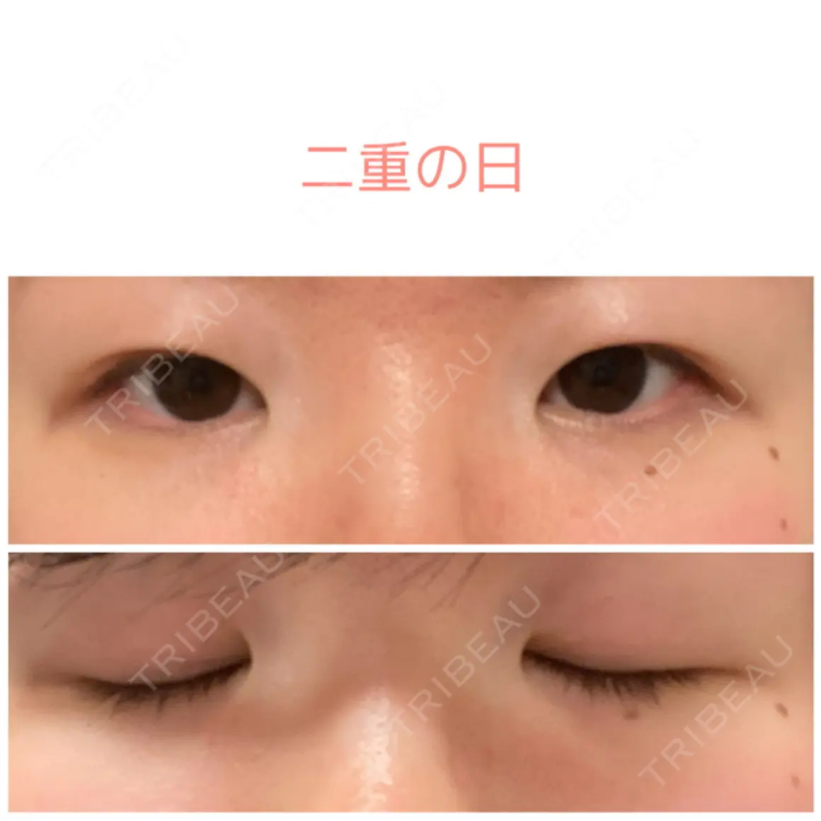 二重切開 / 上まぶたの脂肪取り 聖心美容クリニック 札幌院 AFTER