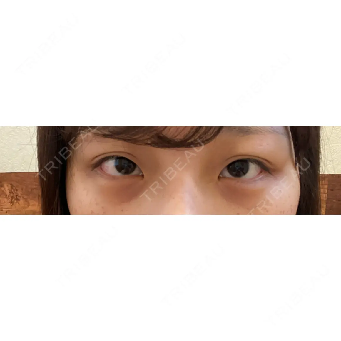 二重埋没 MIL CLINIC OSAKA AFTER