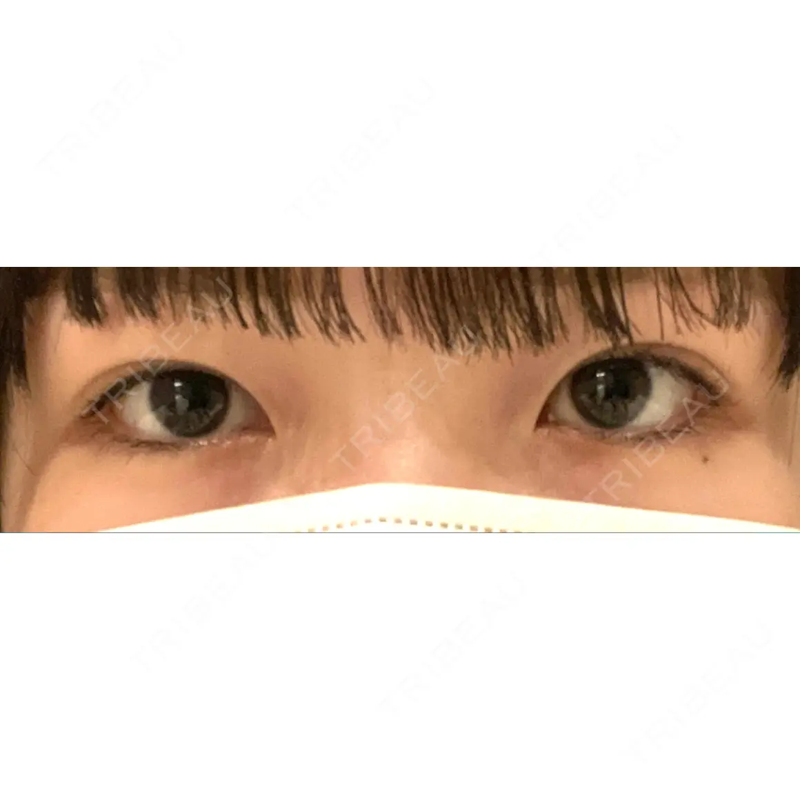 二重埋没 ハナビューティークリニック AFTER