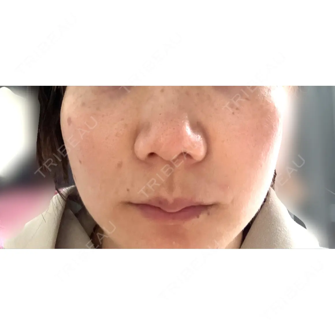 ピコレーザートーニング（美白・肝斑） レディアス美容クリニック恵比寿 AFTER