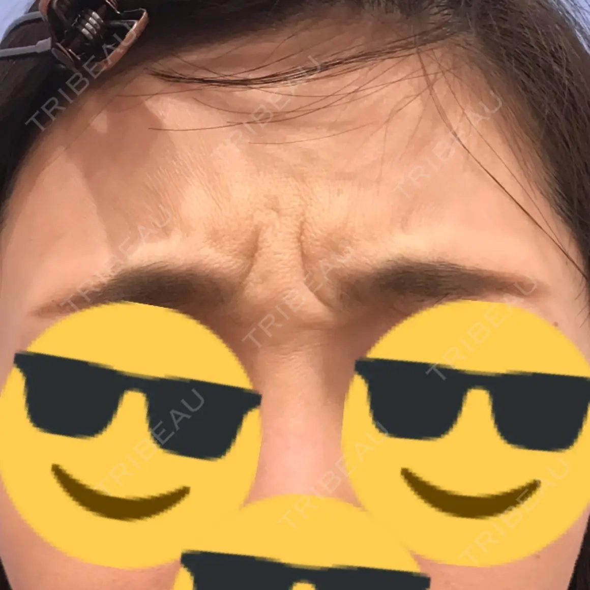 ボトックス（あご） 湘南美容クリニック 渋谷院 AFTER