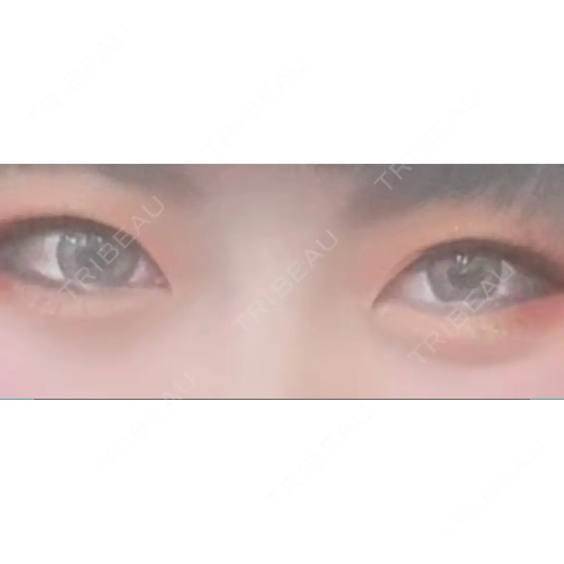 下まぶたの脂肪取り / 美容点滴・美容注射（美肌） / ヒアルロン酸溶解 品川美容外科 渋谷院（※品川スキンクリニック提携） AFTER