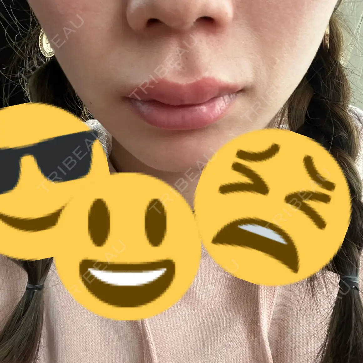 ボトックス（口角） / ボトックス（人中） EMMO FACE CLINIC 大宮院 AFTER