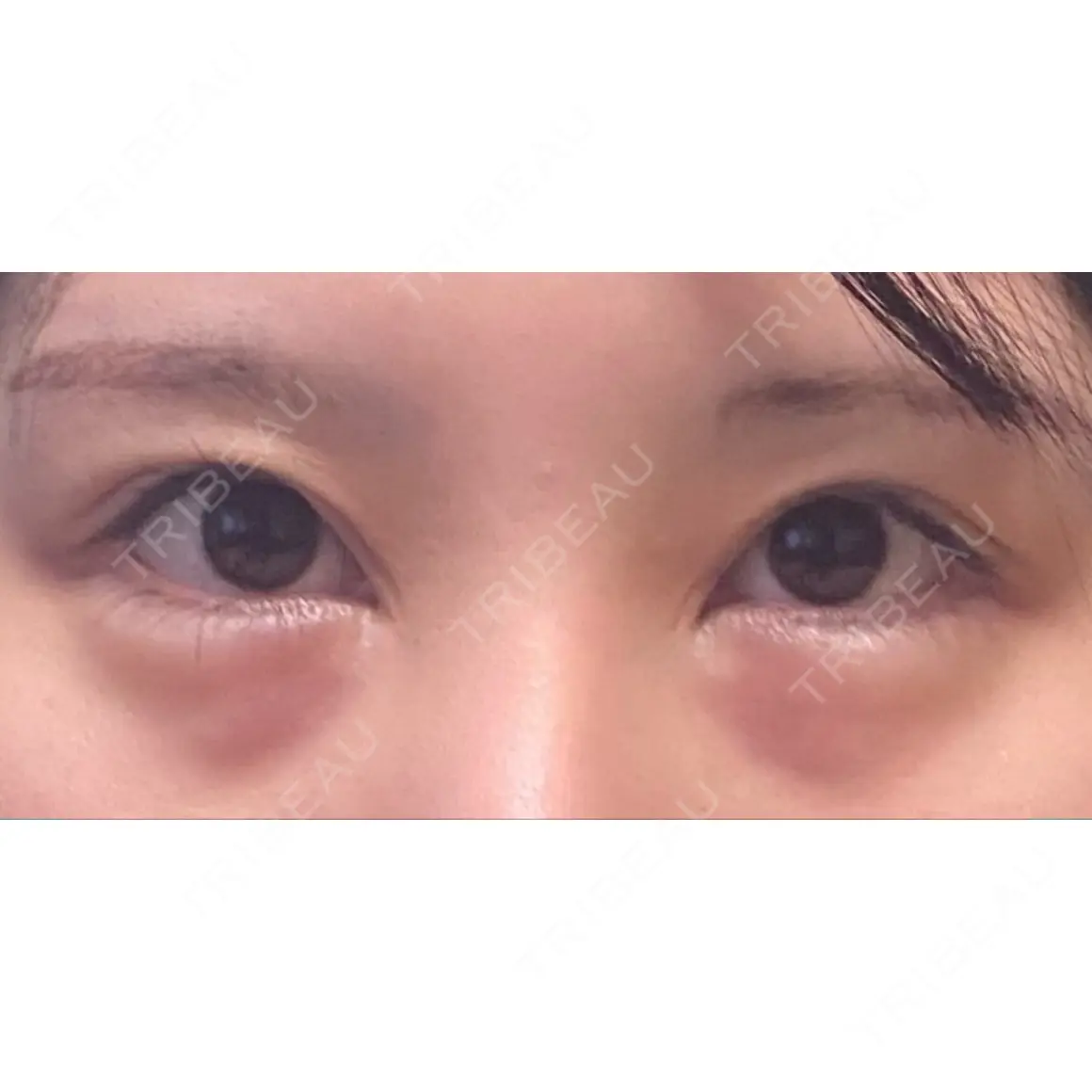 目頭切開 / クマ治療 / 眉下切開 エイペックス美容外科 AFTER