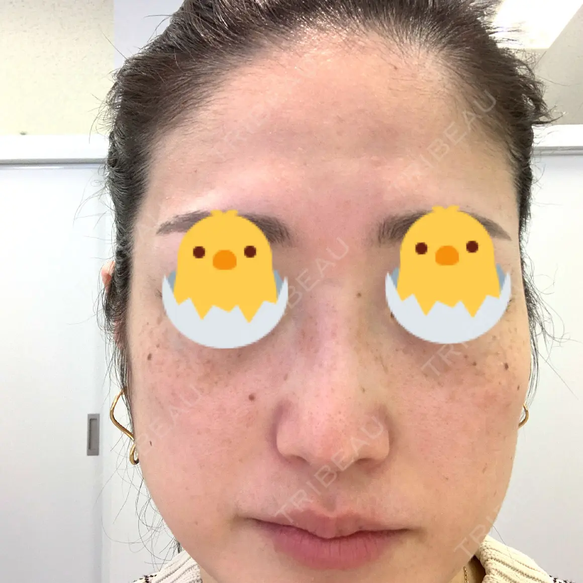 ダーマペン MSC LUNA CLINIC 渋谷院 AFTER