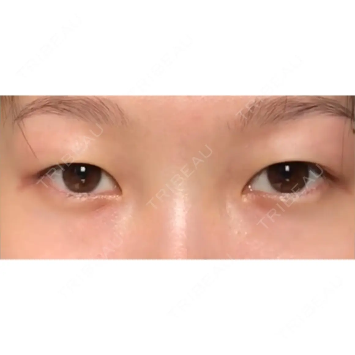二重埋没 プレシャスクリニック自由が丘 AFTER