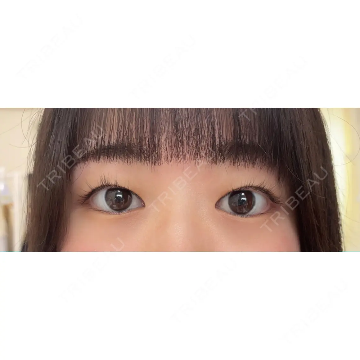 二重埋没 湘南美容クリニック 池袋東口院 AFTER