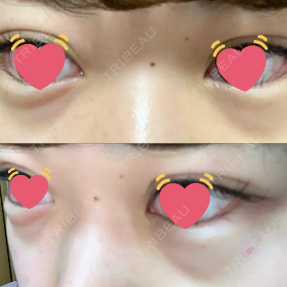 下まぶたたるみ取り 宇都宮竹内クリニック AFTER