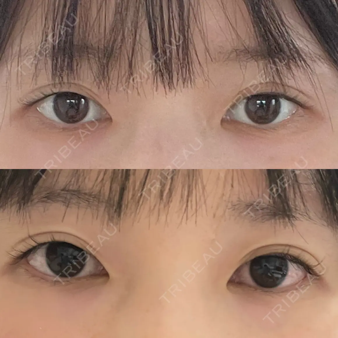 二重切開 / 眼瞼下垂（切開） / 目尻切開 / タレ目形成・グラマラスライン（切開） eクリニック 金沢本院 AFTER
