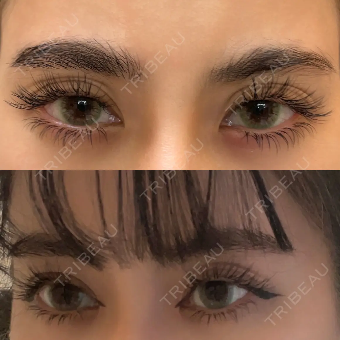 二重埋没 / 目頭切開 / 目尻切開 / タレ目形成・グラマラスライン（切開） HAAB×DREAM BEAUTY CLINIC 東京本院 AFTER