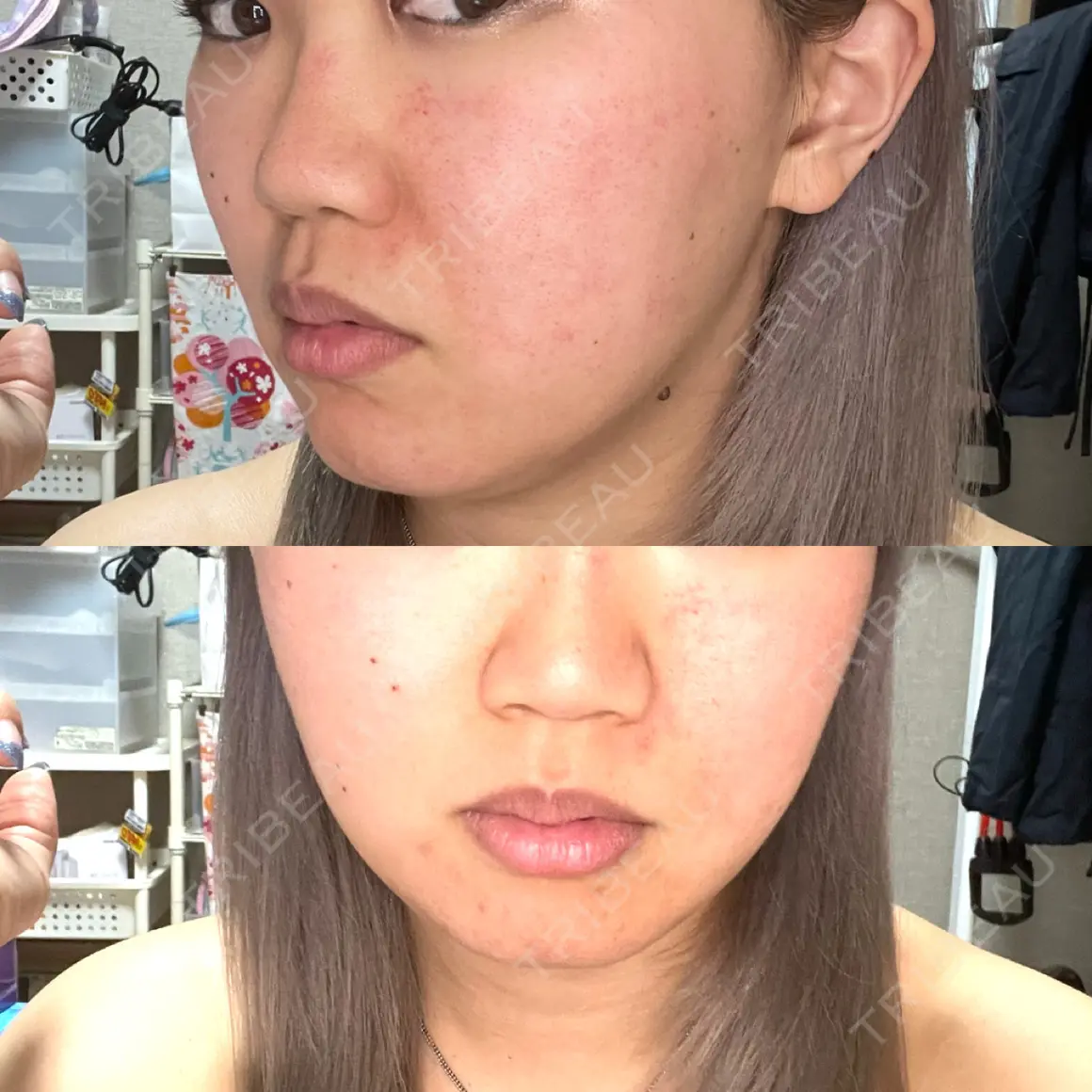 ダーマペン MSC LUNA CLINIC 渋谷院 AFTER