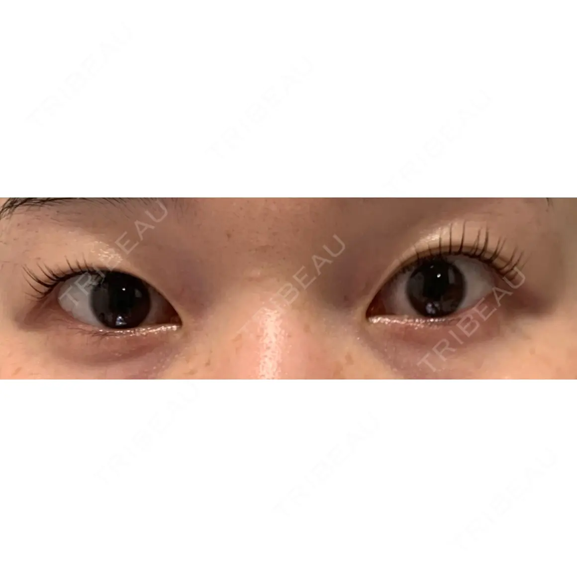 二重埋没 BIANCA銀座 AFTER