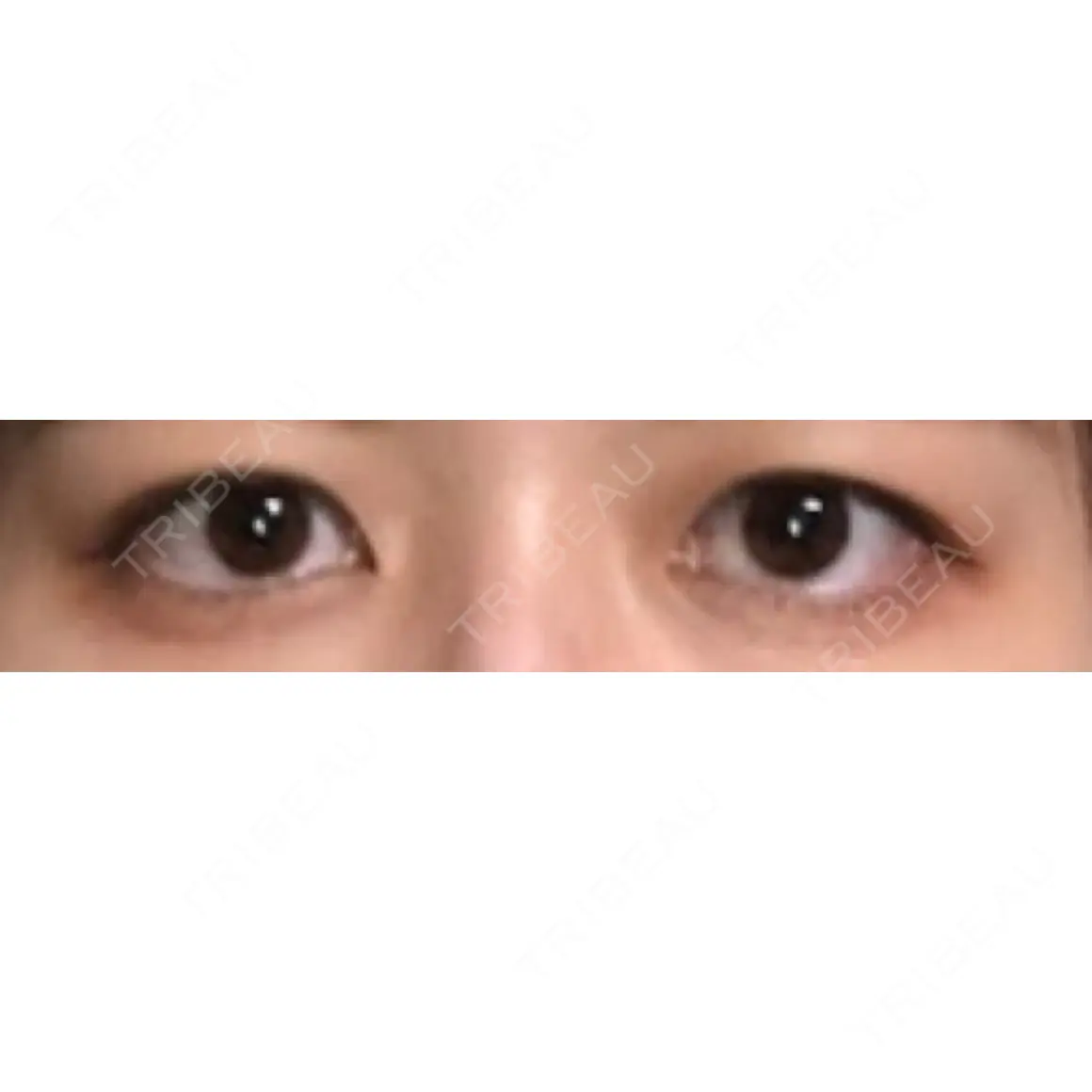二重埋没 オアシス美容外科 AFTER