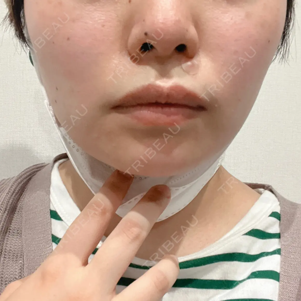 ボトックス（エラ・小顔） 東京美容外科 梅田院 AFTER