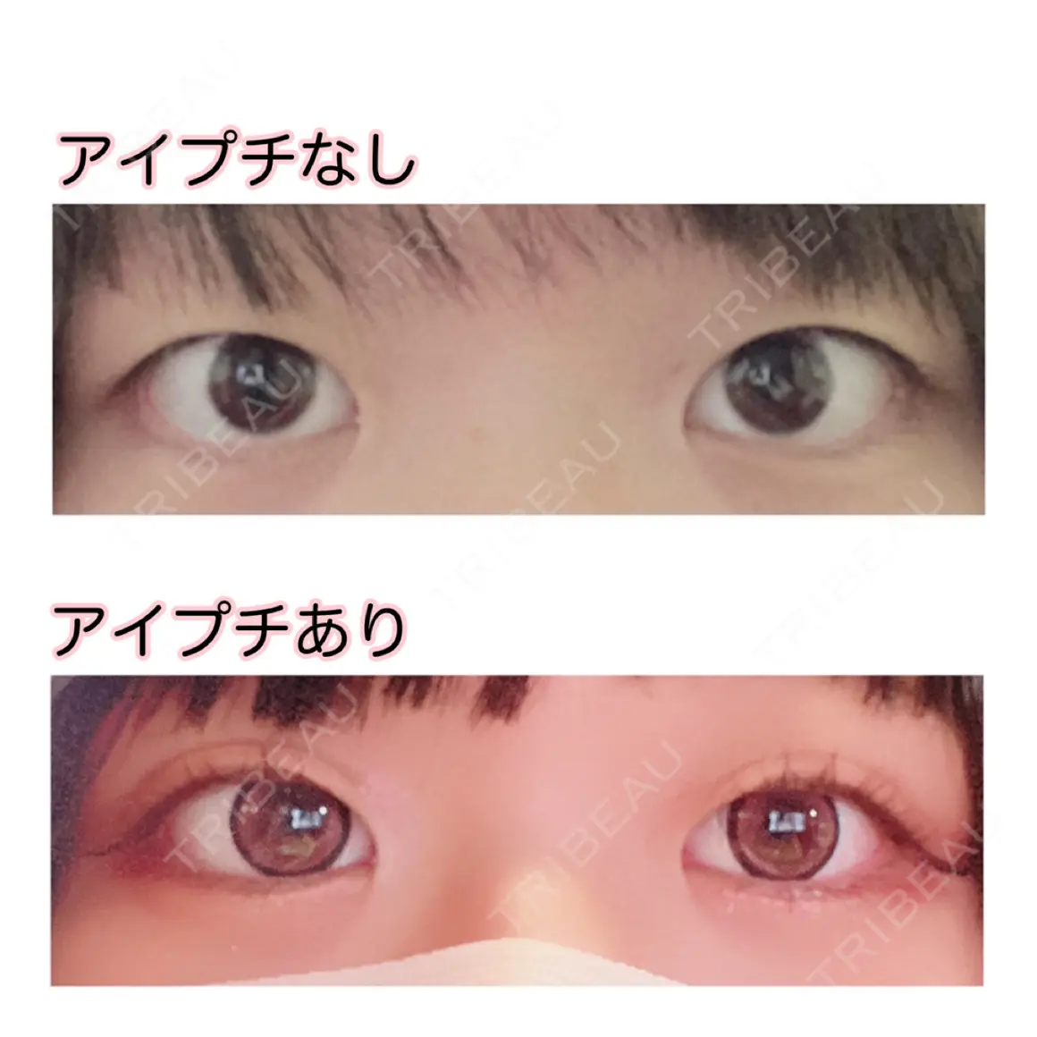 自然癒着法 シンデレラ＆ダヴィンチクリニック AFTER