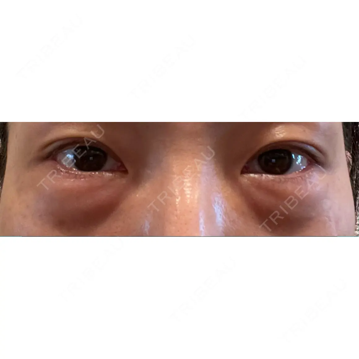 二重埋没 / 下まぶたたるみ取り / 下まぶたの脂肪取り お茶の水美容形成クリニック AFTER