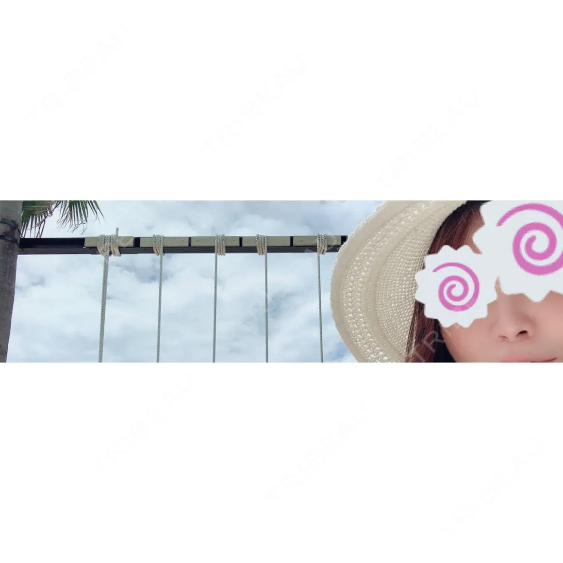 ヒアルロン酸注入（涙袋） / ヒアルロン酸注入（鼻） BIANCA表参道 AFTER