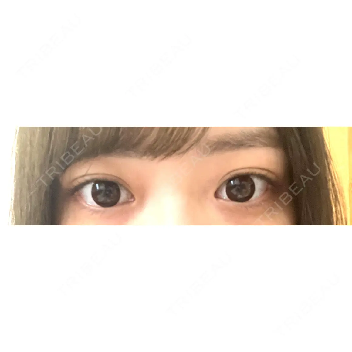 ヒアルロン酸注入（涙袋） フィラークリニック 大阪心斎橋院 AFTER