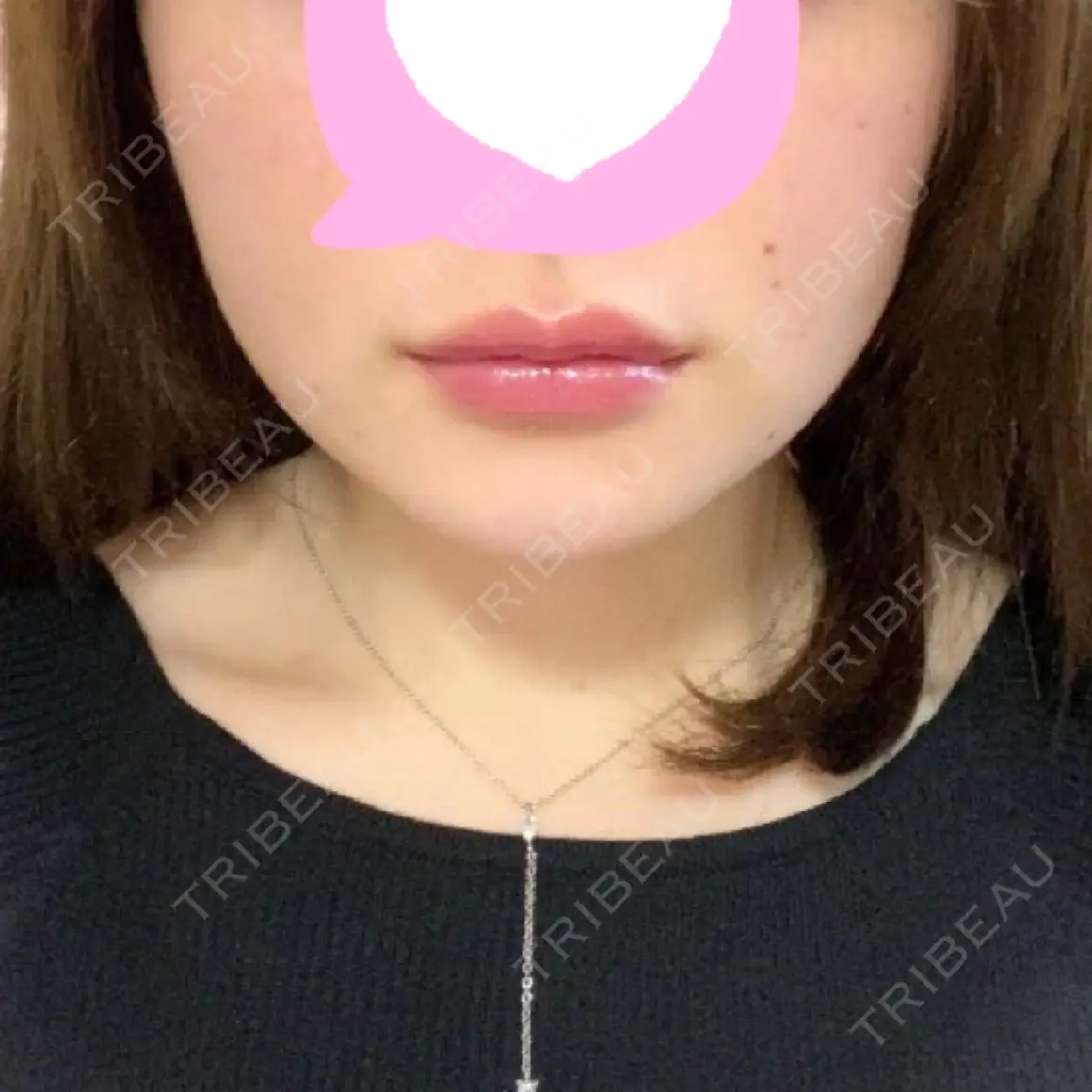 脂肪吸引（顔） 渋谷美容外科クリニック 渋谷院 AFTER