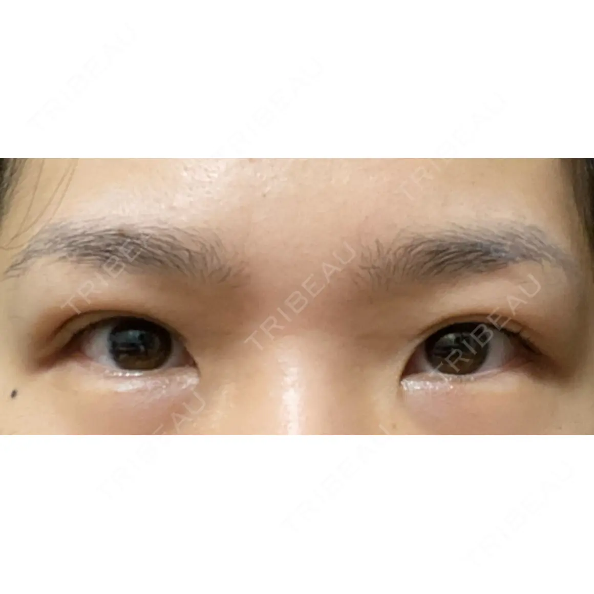 ヒアルロン酸注入（涙袋） / ヒアルロン酸注入（唇） 渋谷美容外科クリニック 池袋院 AFTER