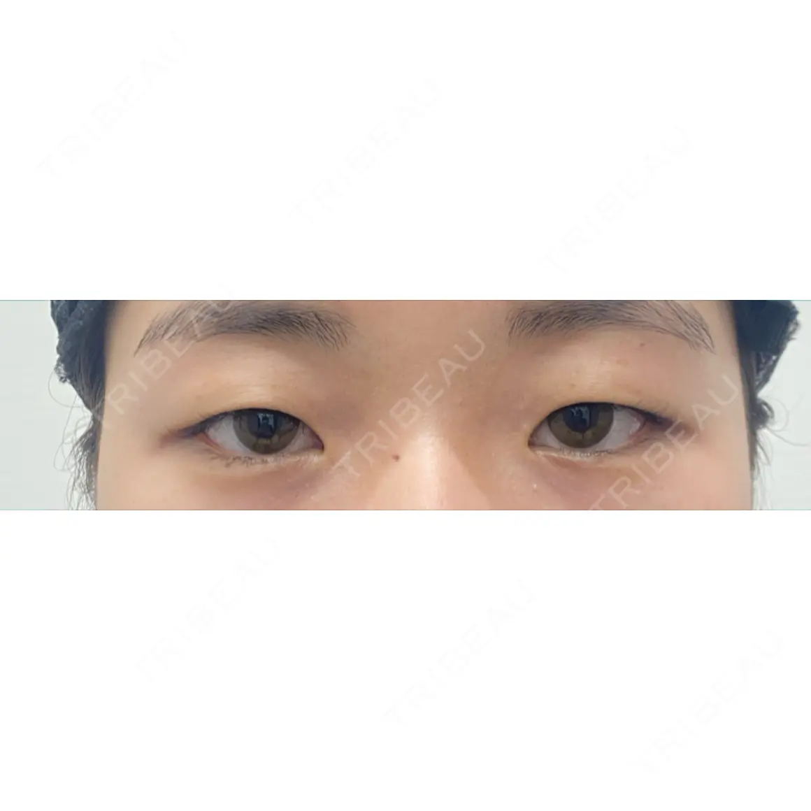 二重埋没 / 上まぶたの脂肪取り 湘南美容クリニック 池袋東口院 AFTER