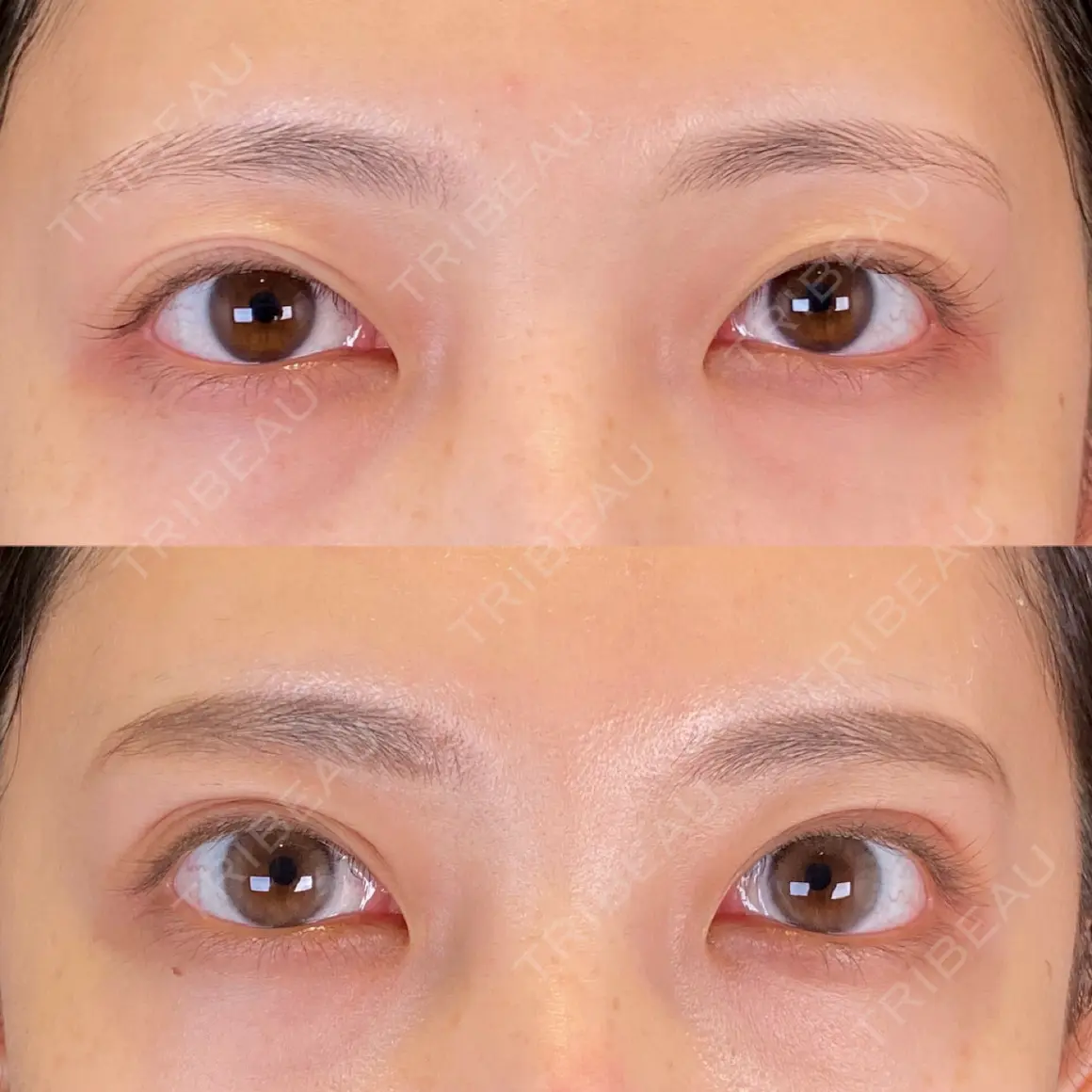 二重埋没 / ボトックス（肩） SOL CLINIC AFTER