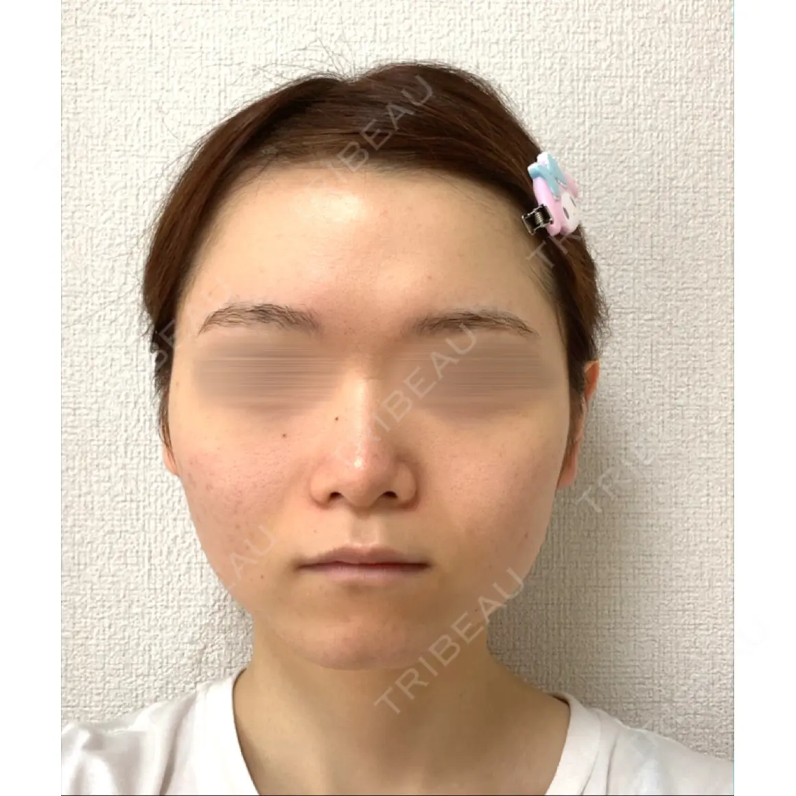 糸リフト / バッカルファット除去 / 脂肪吸引（顔） / ボトックス（あご） / ヒアルロン酸注入（あご） / ボトックス（エラ・小顔） / ヒアルロン酸注入（唇） / その他（口元） アリエル美容クリニック 大宮院 AFTER