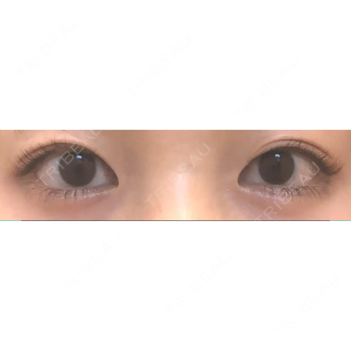 二重埋没 お茶の水美容形成クリニック AFTER
