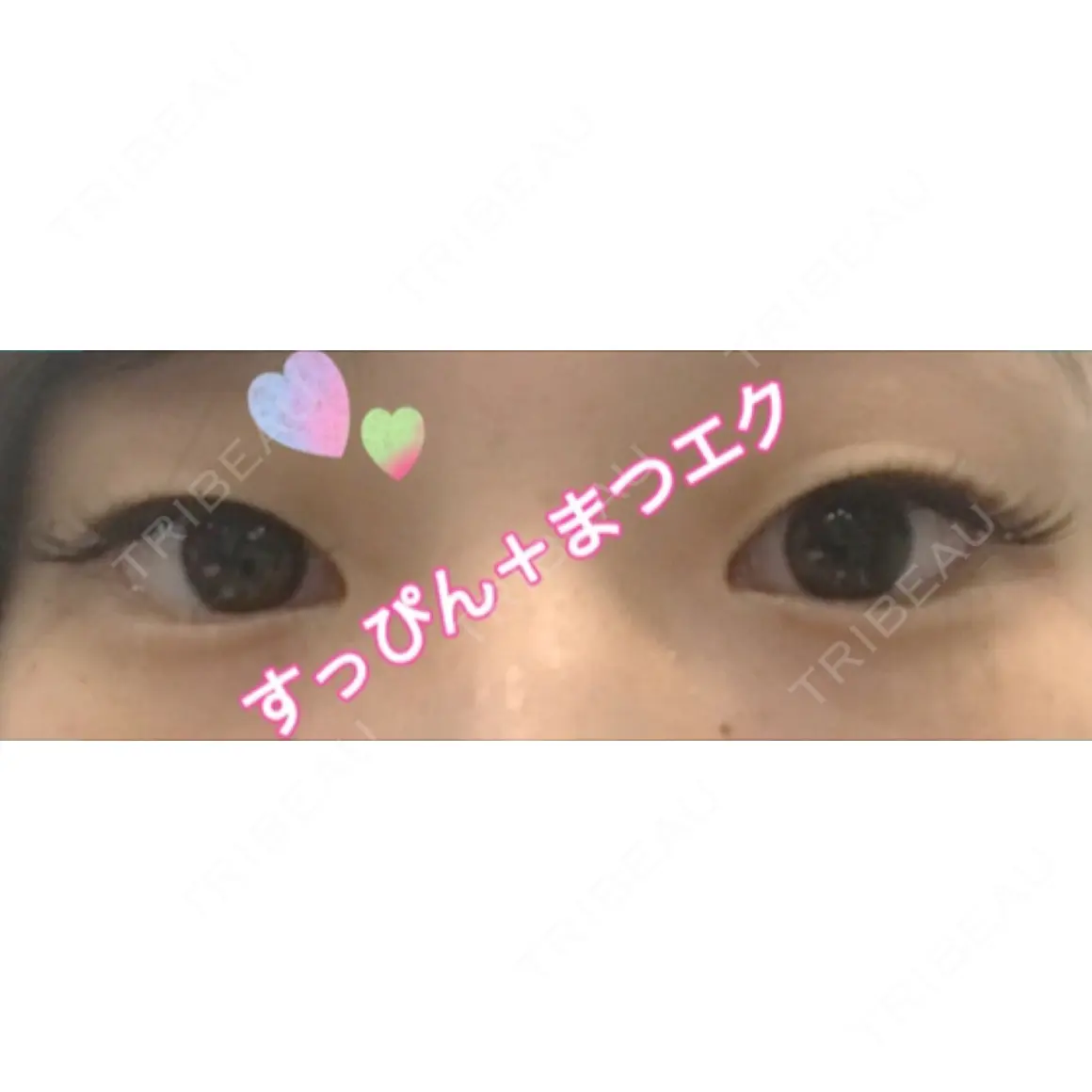 二重埋没 共立美容外科 渋谷院 AFTER