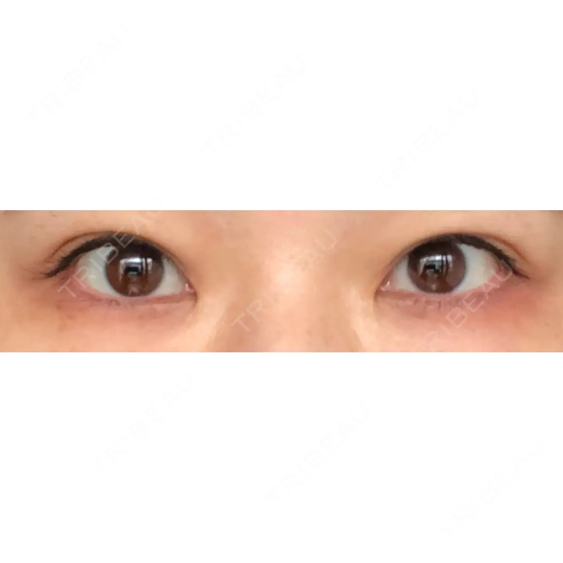 目尻切開 / 下まぶたたるみ取り / 下まぶたの脂肪取り / タレ目形成・グラマラスライン（切開） 湘南美容クリニック 表参道院 AFTER