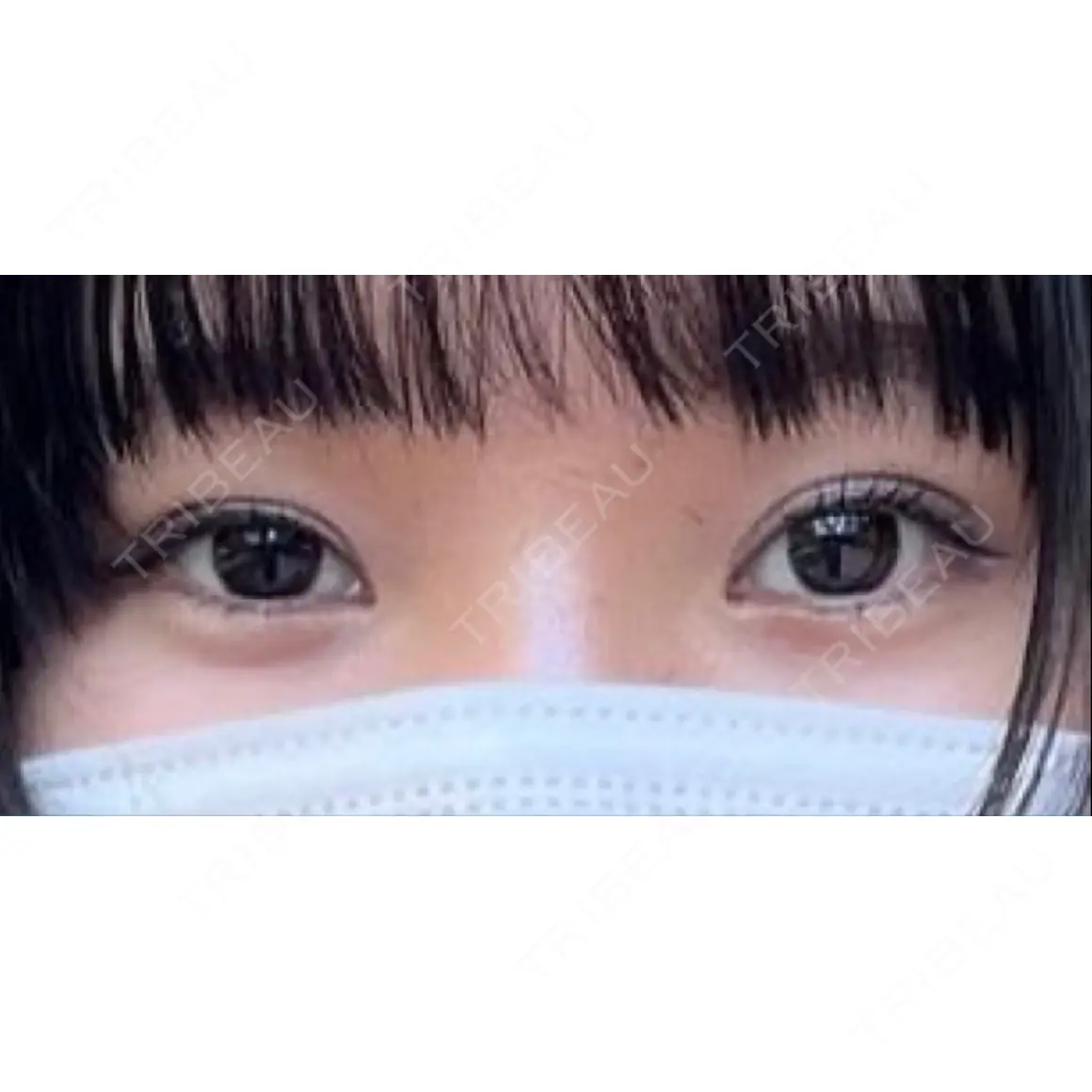 二重埋没 ルラ美容クリニック 新宿院 AFTER