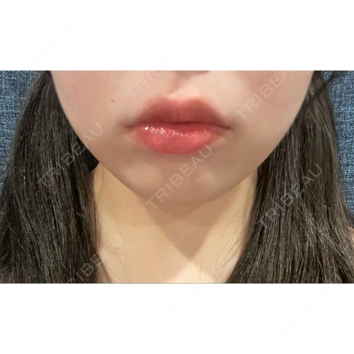 ボトックス（あご） / ヒアルロン酸注入（あご） / 脂肪溶解注射（顔） / ヒアルロン酸注入（唇） / ボトックス（口角） ルラ美容クリニック 新宿院 AFTER