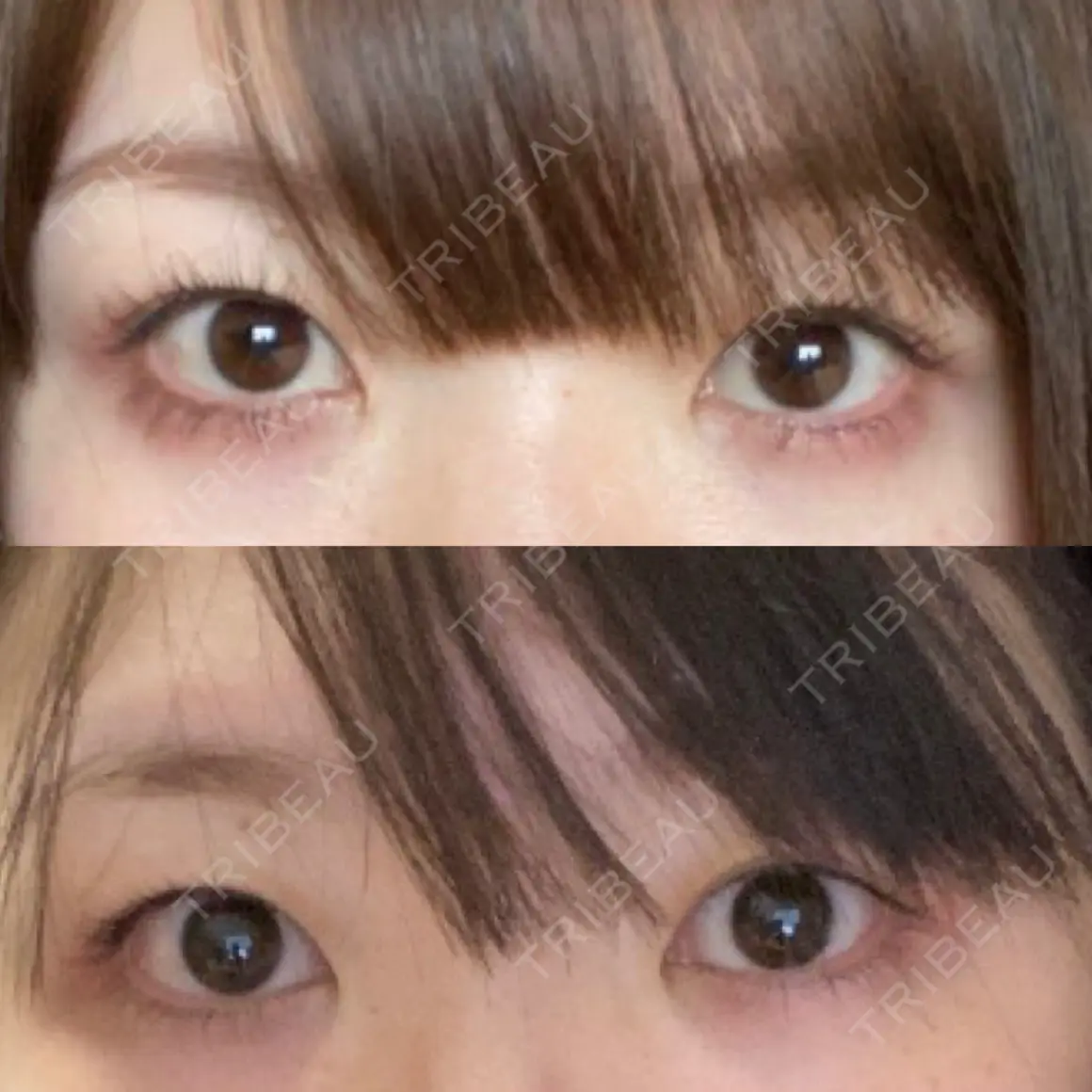 二重埋没 オアシス美容外科 AFTER