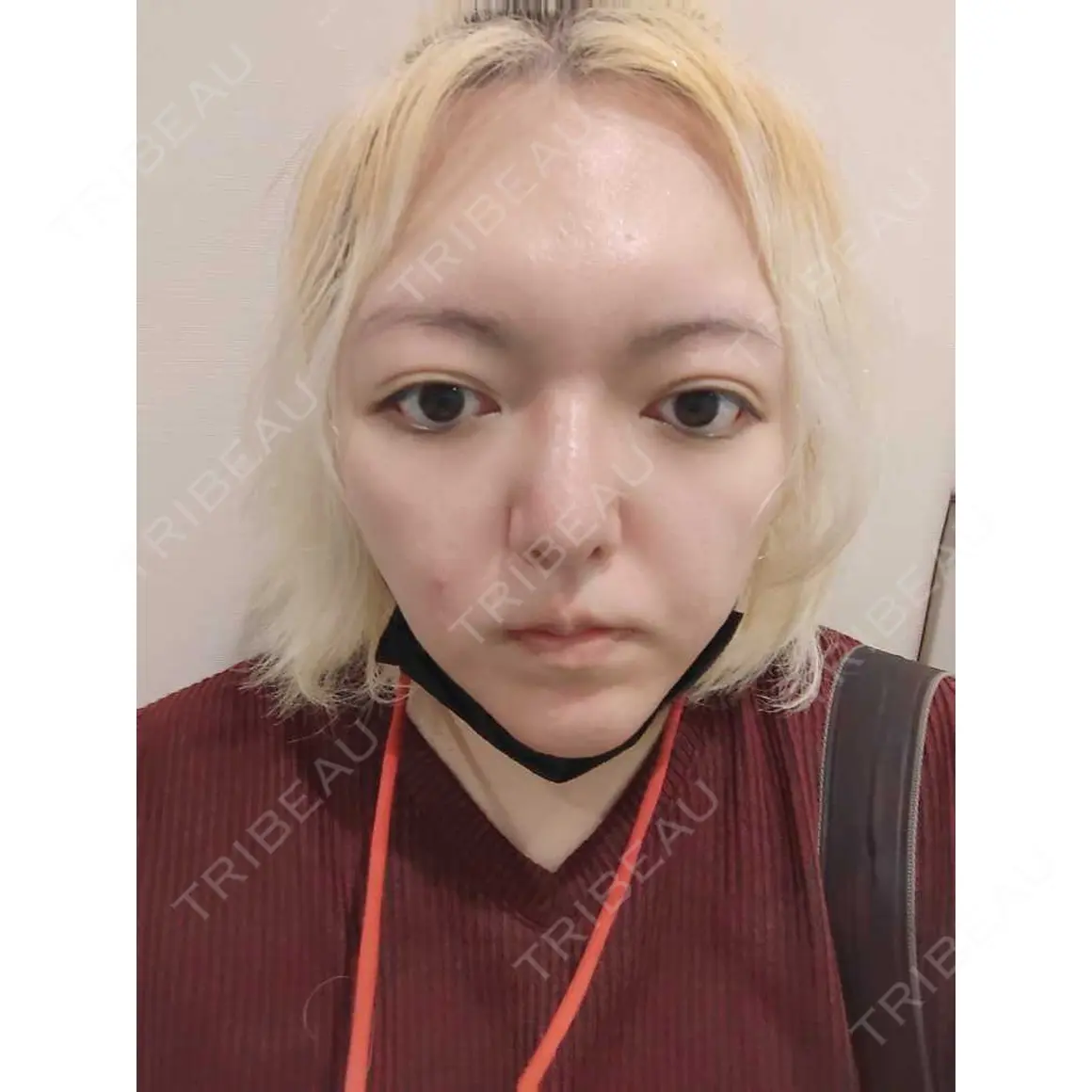 鼻尖縮小 / 鼻尖形成（非切開） 品川美容外科 新宿院（※品川スキンクリニック提携） AFTER