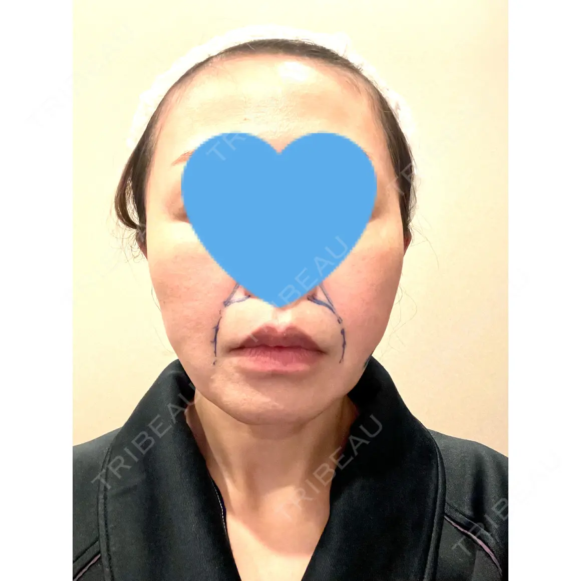 脂肪注入（輪郭） THE CLINIC（ザ・クリニック） 名古屋院 AFTER