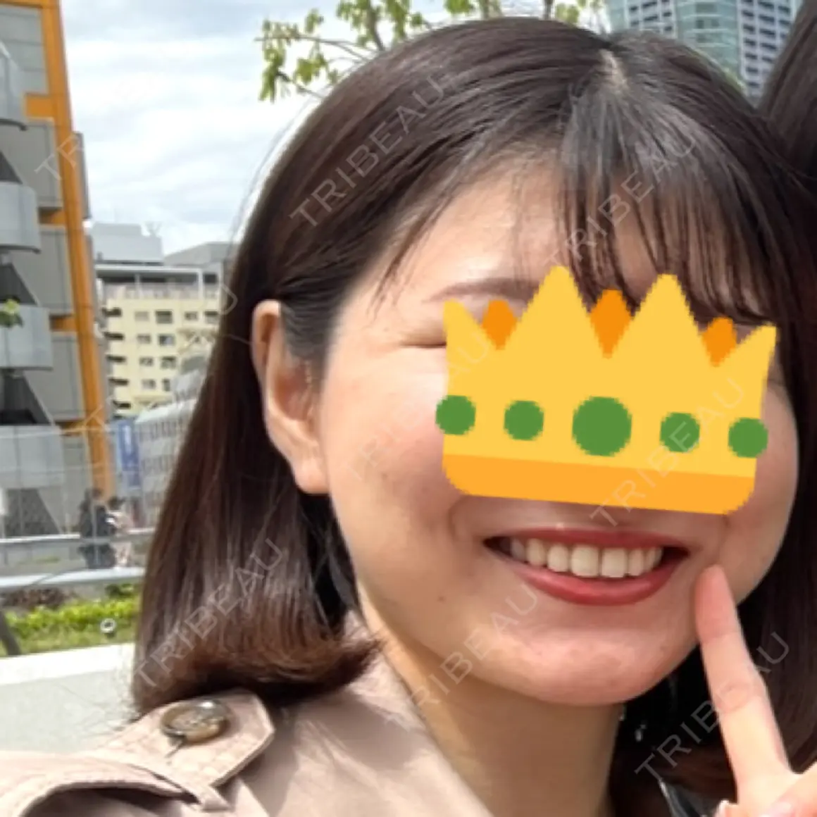 脂肪吸引（顔） 渋谷美容外科クリニック 渋谷院 AFTER