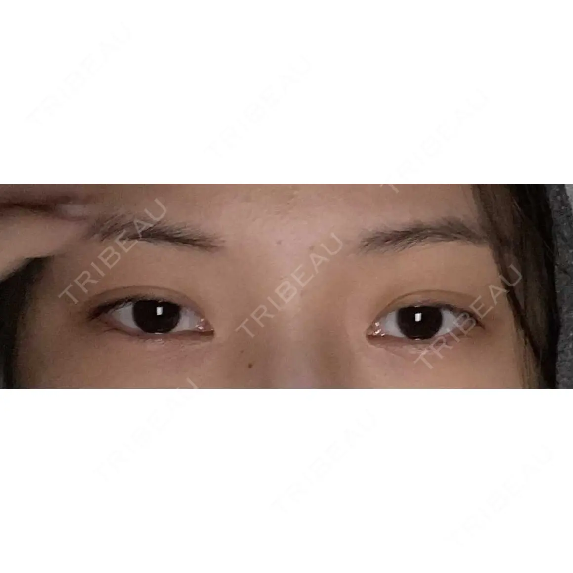 二重埋没 プロミス整形外科 AFTER